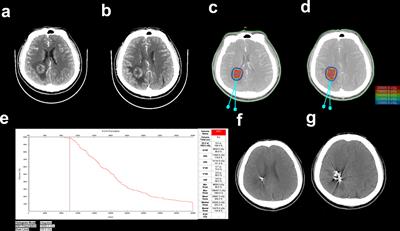 Iodine-125 brachytherapy treatment for newly diagnosed brain metastasis in non-small cell lung cancer: A biocentric analysis